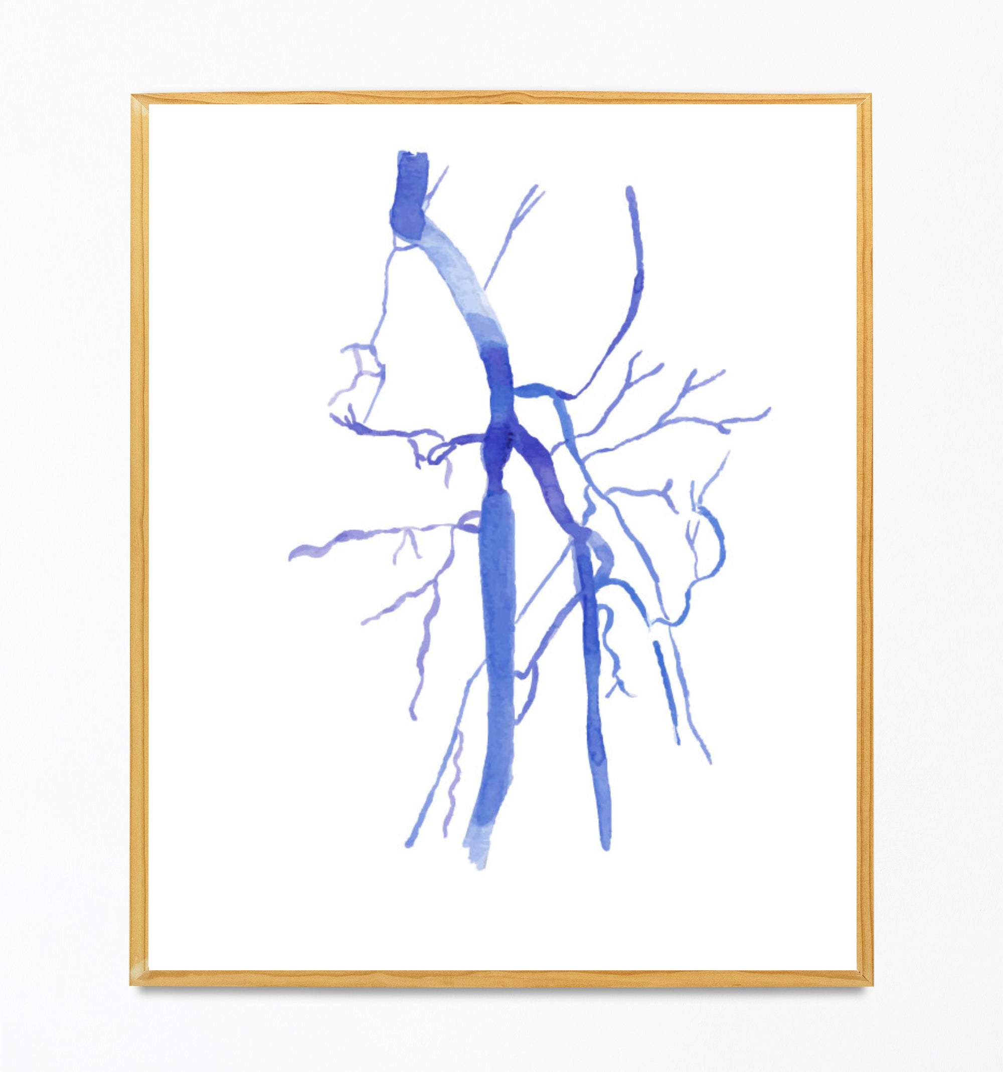 Lower limb DSA angiography art print