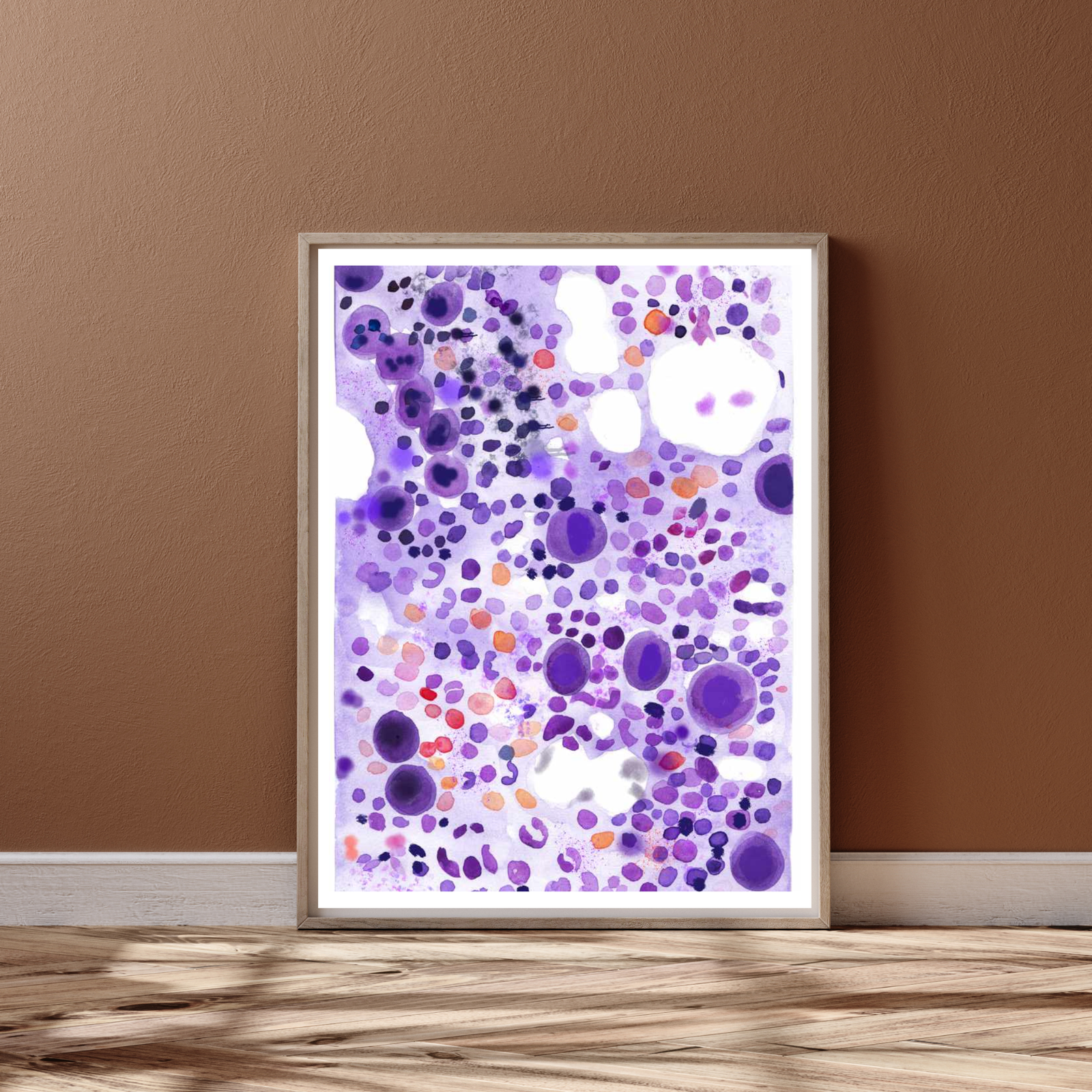 ITP - Idiopathic Thrombocytopenia Bone Marrow Aspirate