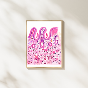 Stomach Signet Ring Carcinoma Histopathology Art