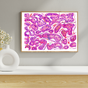 Hepatocellular Carcinoma Histopathology Art