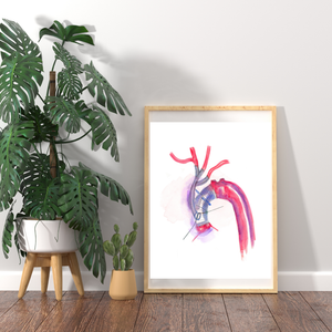 Aorta Aneurysm Repair Art Print