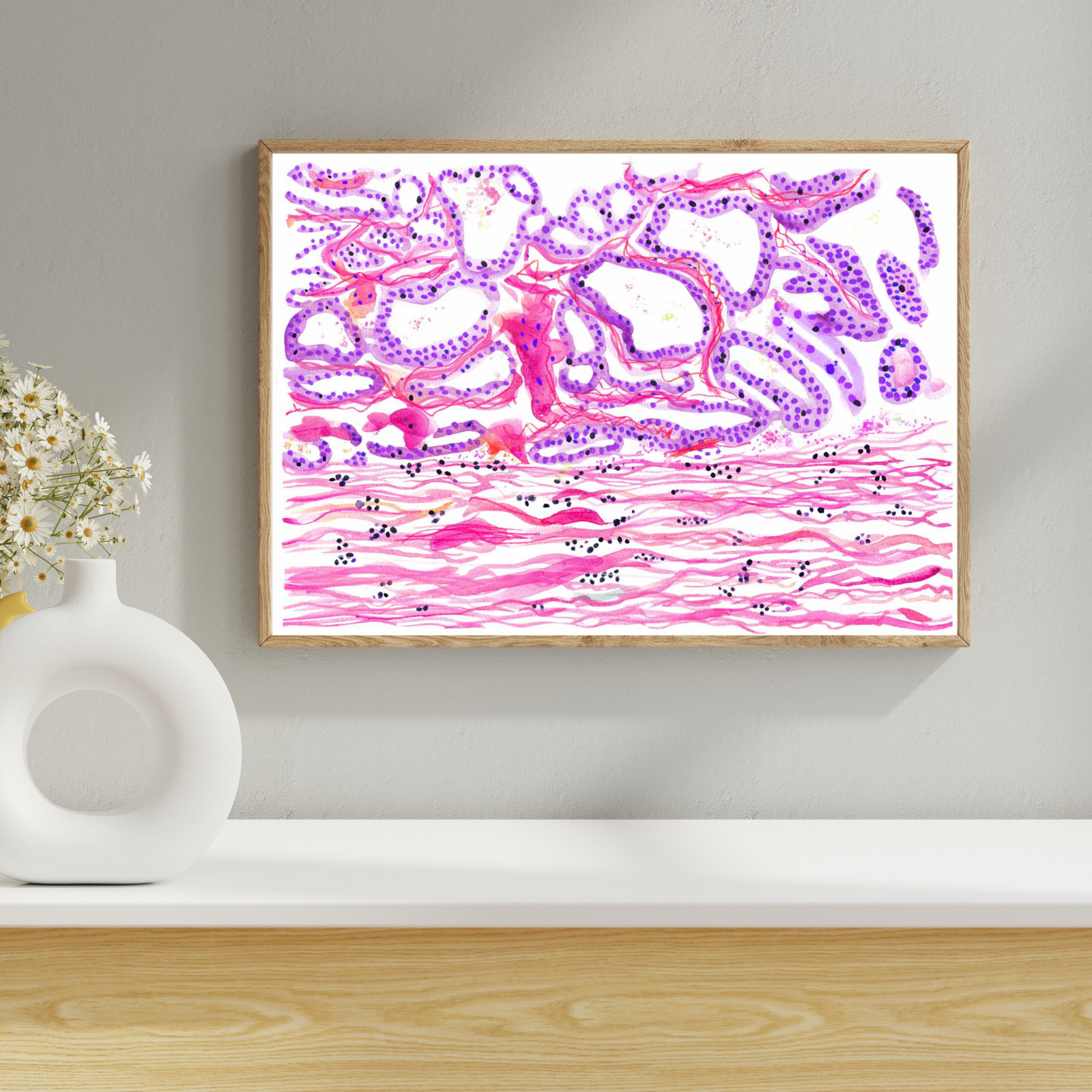Breast Cancer Histopathology Art - Papillary Carcinoma