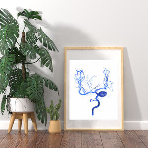 Brain Aneurysm Coiling Art Print