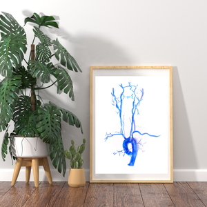 Carotid Angiography Post Stenting Watercolor Art Print