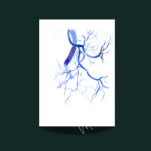 Prostatic Artery Embolization Watercolor Art print