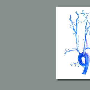 Carotid Angiography Post Stenting Watercolor Art Print