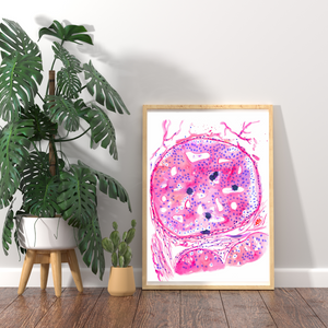 Breast Cancer Histopathology Art - DCIS