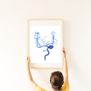 Brain Aneurysm Coiling Art Print