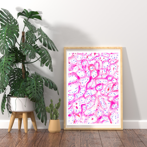 Renal Clear Cell Carcinoma Histopathology Art Print