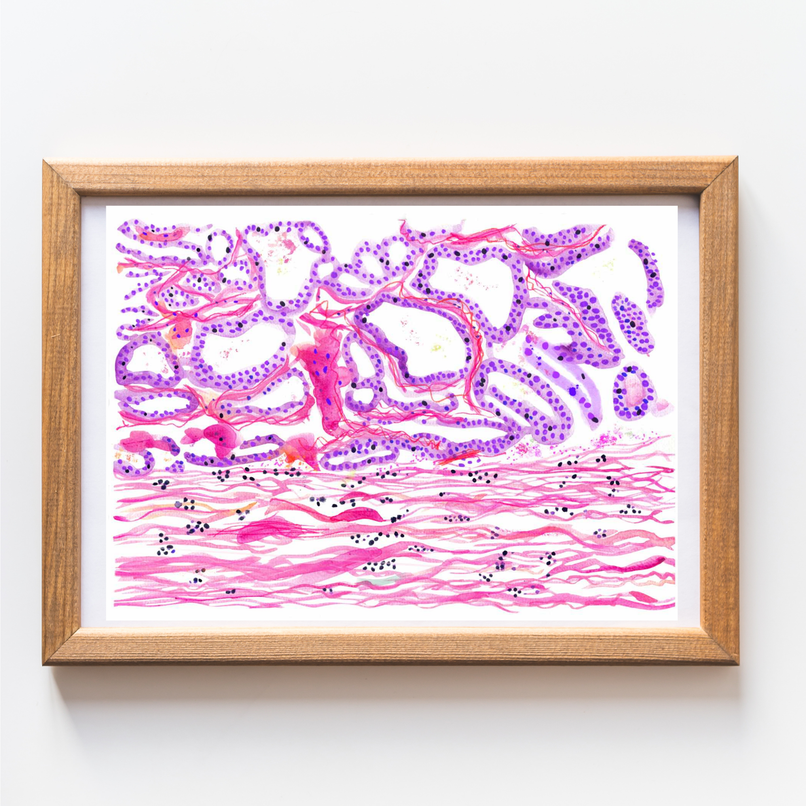 Breast Cancer Histopathology Art - Papillary Carcinoma