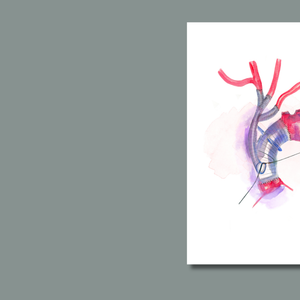 Aorta Aneurysm Repair Art Print