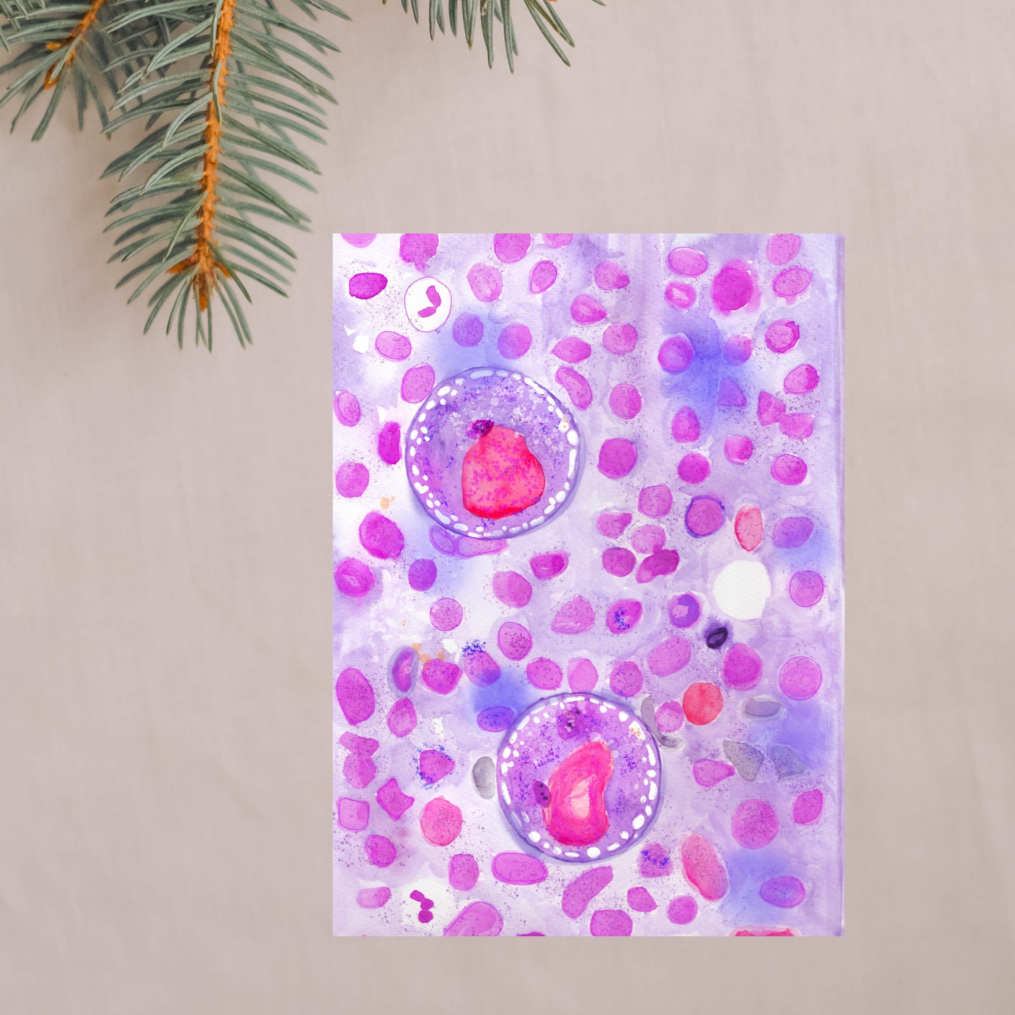 hodgkin lymphoma pathology watercolor art print