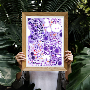 ITP - Idiopathic Thrombocytopenia Bone Marrow Aspirate