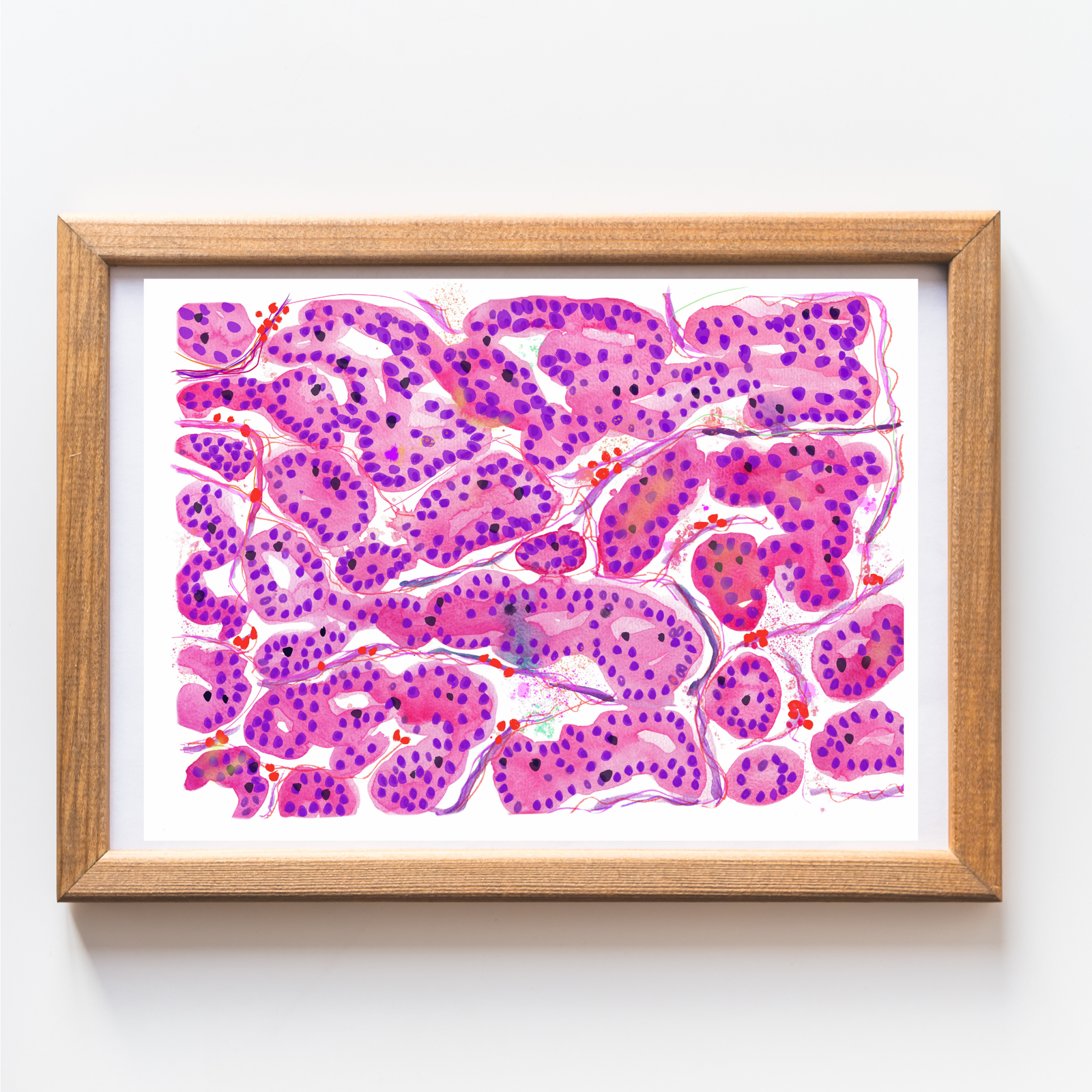 Hepatocellular Carcinoma Histopathology Art