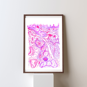 Chronic Conjunctivitis Histopathology Art Print