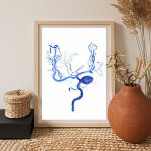 Brain Aneurysm Coiling Art Print