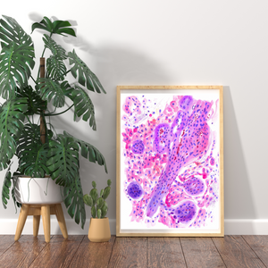 Glioblastoma Neuropathology Watercolor Art Print