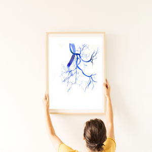 Prostatic Artery Embolization Watercolor Art print
