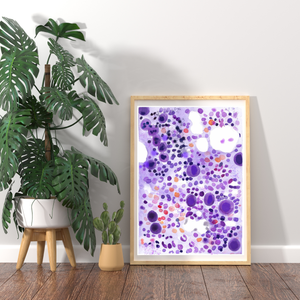 ITP - Idiopathic Thrombocytopenia Bone Marrow Aspirate