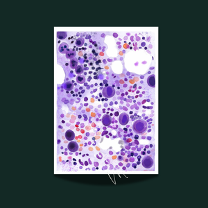 ITP - Idiopathic Thrombocytopenia Bone Marrow Aspirate