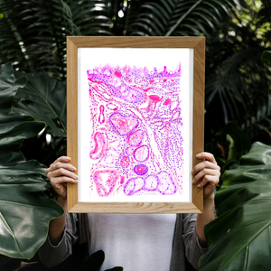 Chronic Conjunctivitis Histopathology Art Print