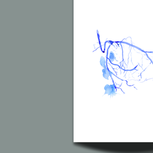 Heart Angiogram - PCI