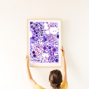 ITP - Idiopathic Thrombocytopenia Bone Marrow Aspirate