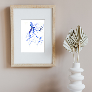 Prostatic Artery Embolization Watercolor Art print