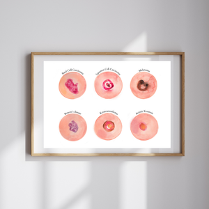 Skin Tumour Watercolor Art