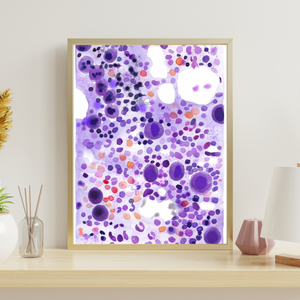 ITP - Idiopathic Thrombocytopenia Bone Marrow Aspirate