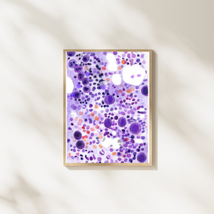 ITP - Idiopathic Thrombocytopenia Bone Marrow Aspirate