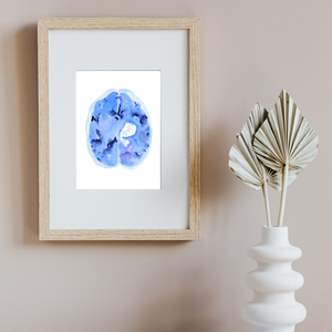 Hemorrhagic Stroke Watercolor Art Print