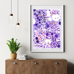 ITP - Idiopathic Thrombocytopenia Bone Marrow Aspirate