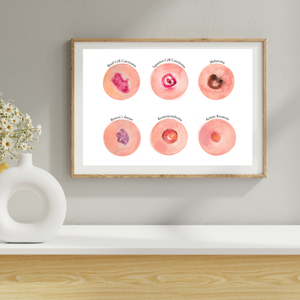 Skin Tumour Watercolor Art