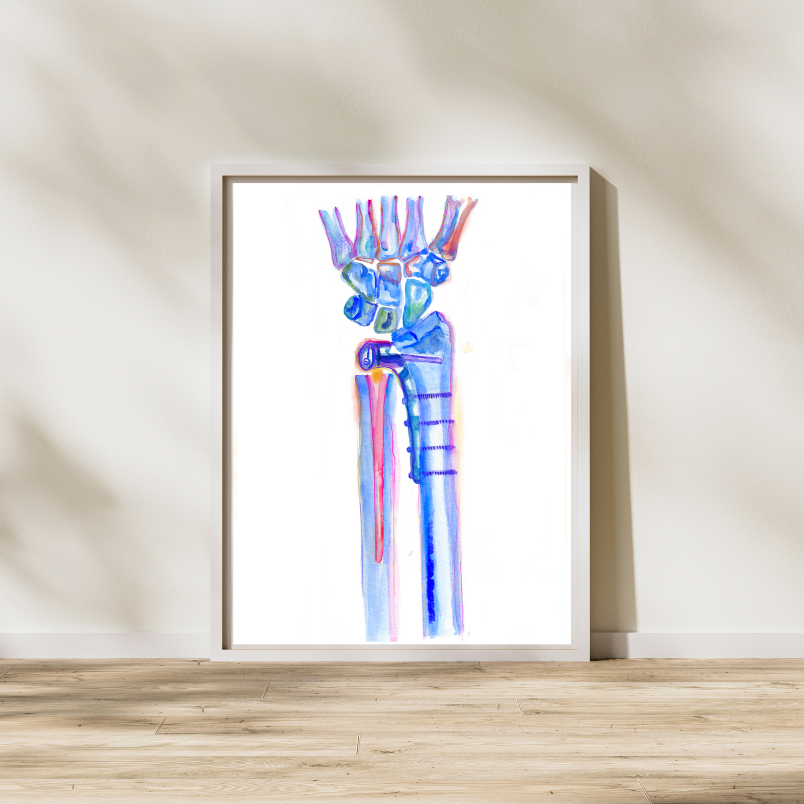 Radioulnar Joint Repair Orthopedic Art