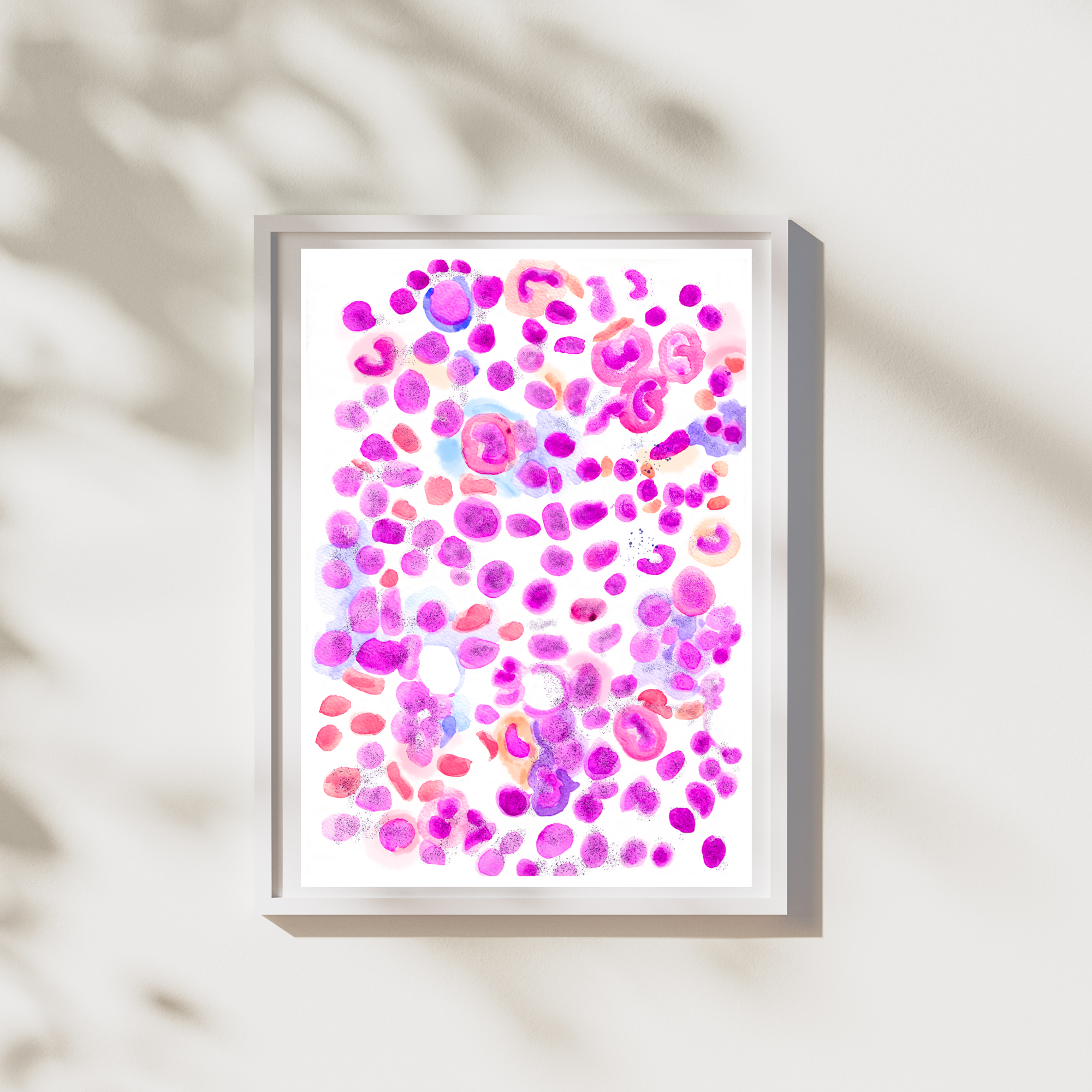 acute lymphoblastic leukemia watercolor art
