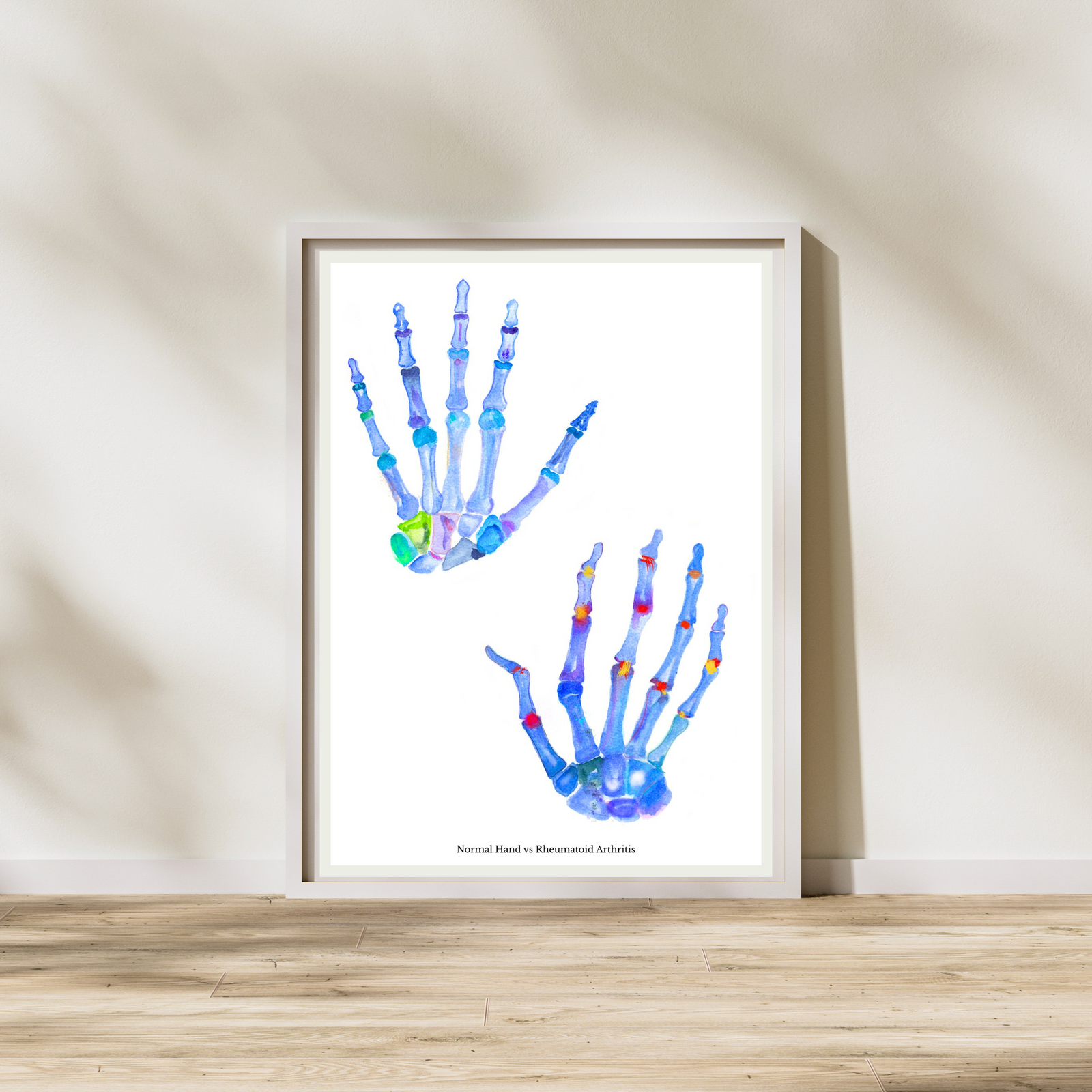 Rheumatoid Arthritis Hand Art