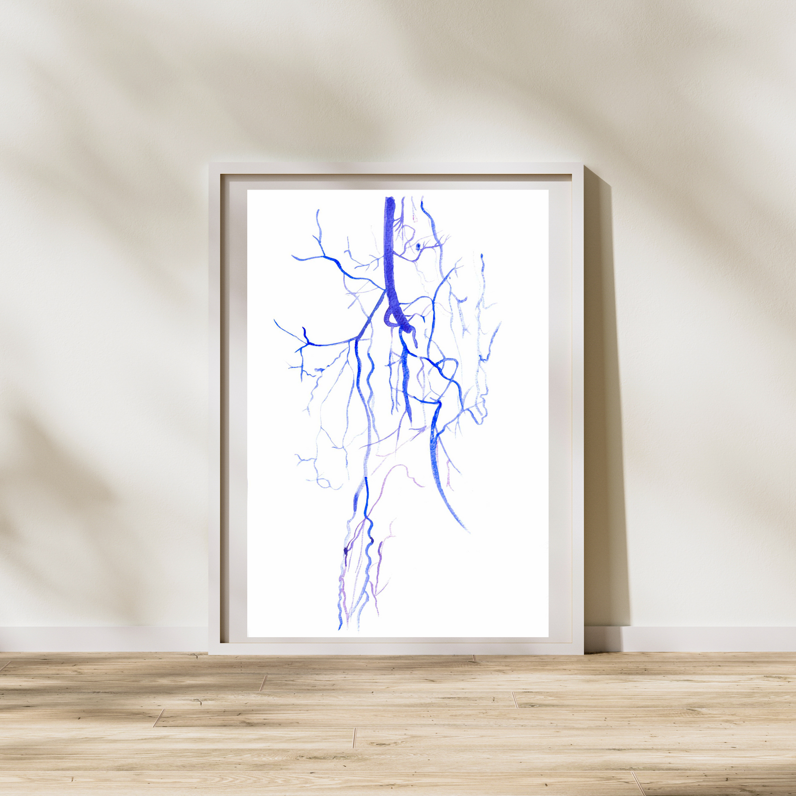 Buerger Disease - Thromboangiitis Obliterans CT Angio