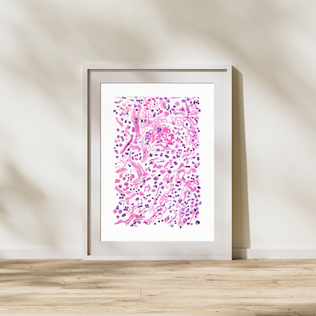 Pneumonia Histopathology Artwork