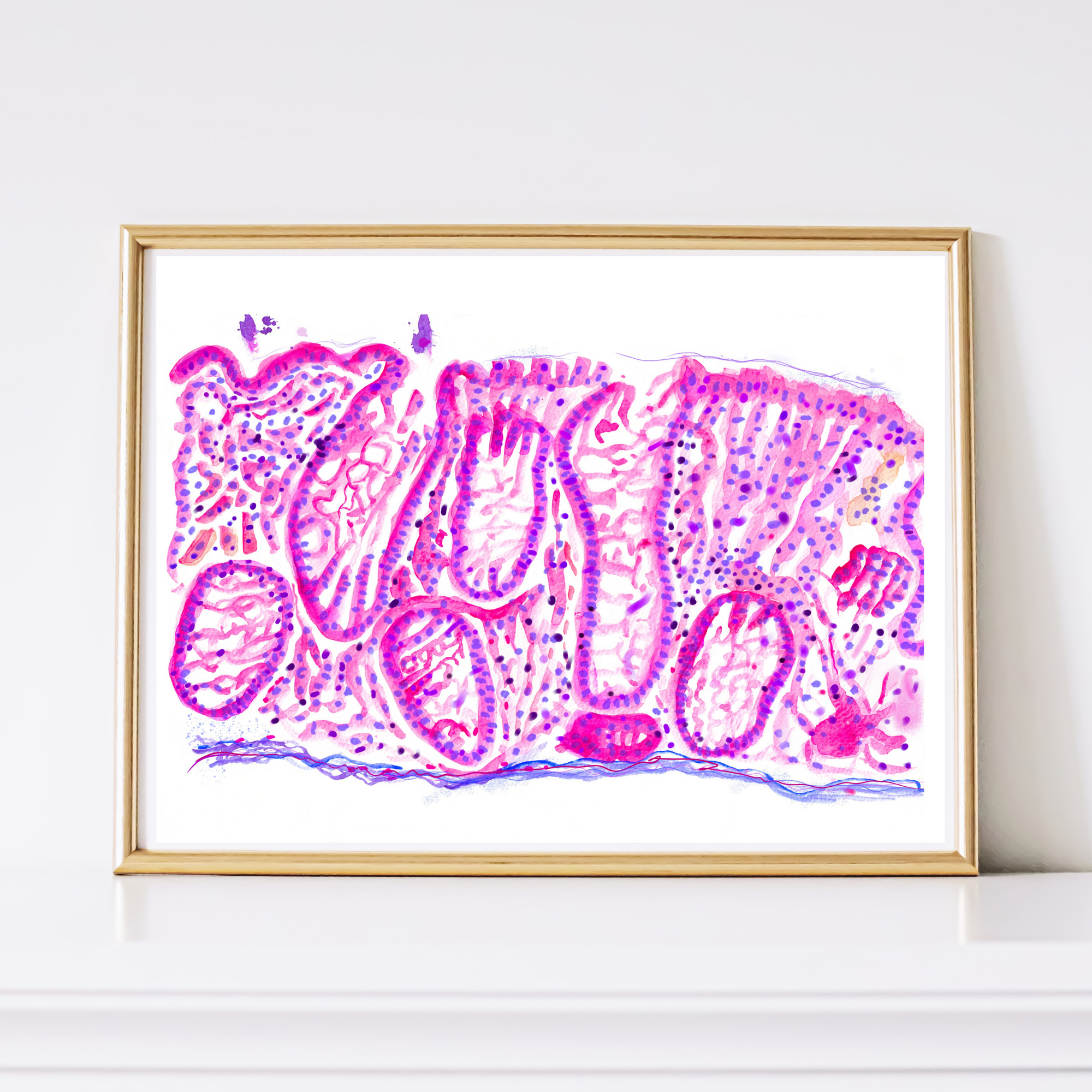 Crohn´s Disease Histopathology Art Print