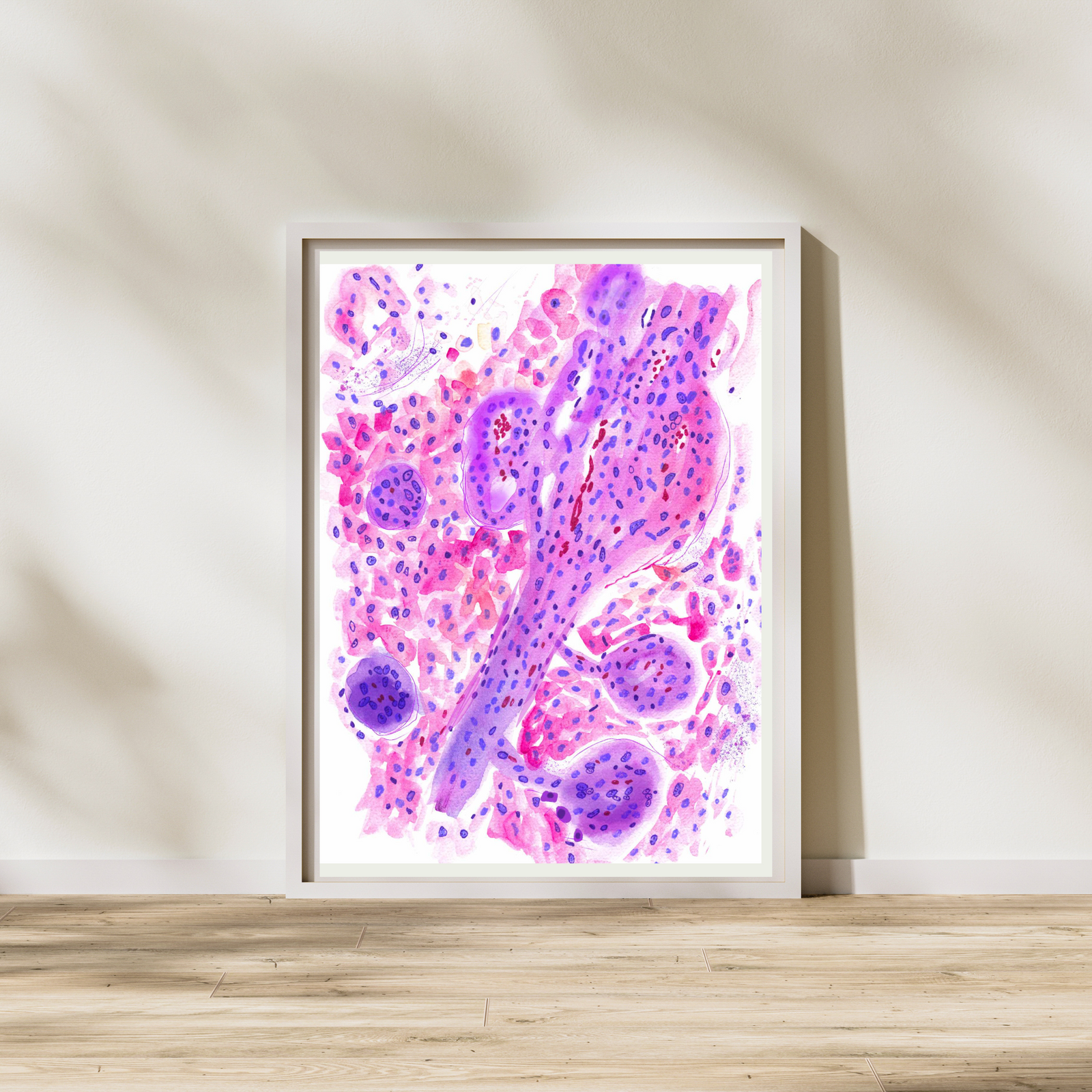 Glioblastoma Neuropathology Watercolor Art Print