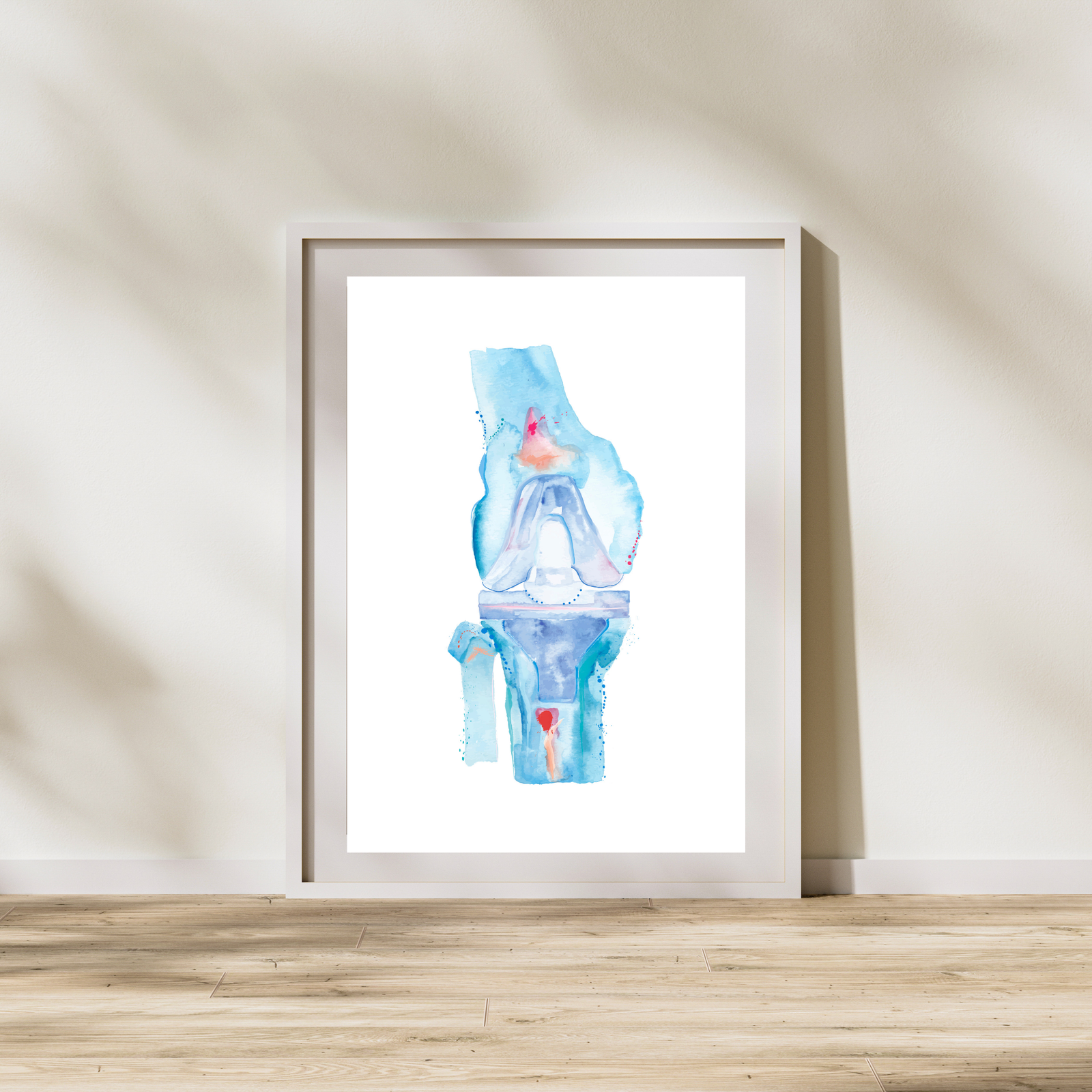 Knee Replacement Surgery Art Print, Orthopedic Surgery Wall Art