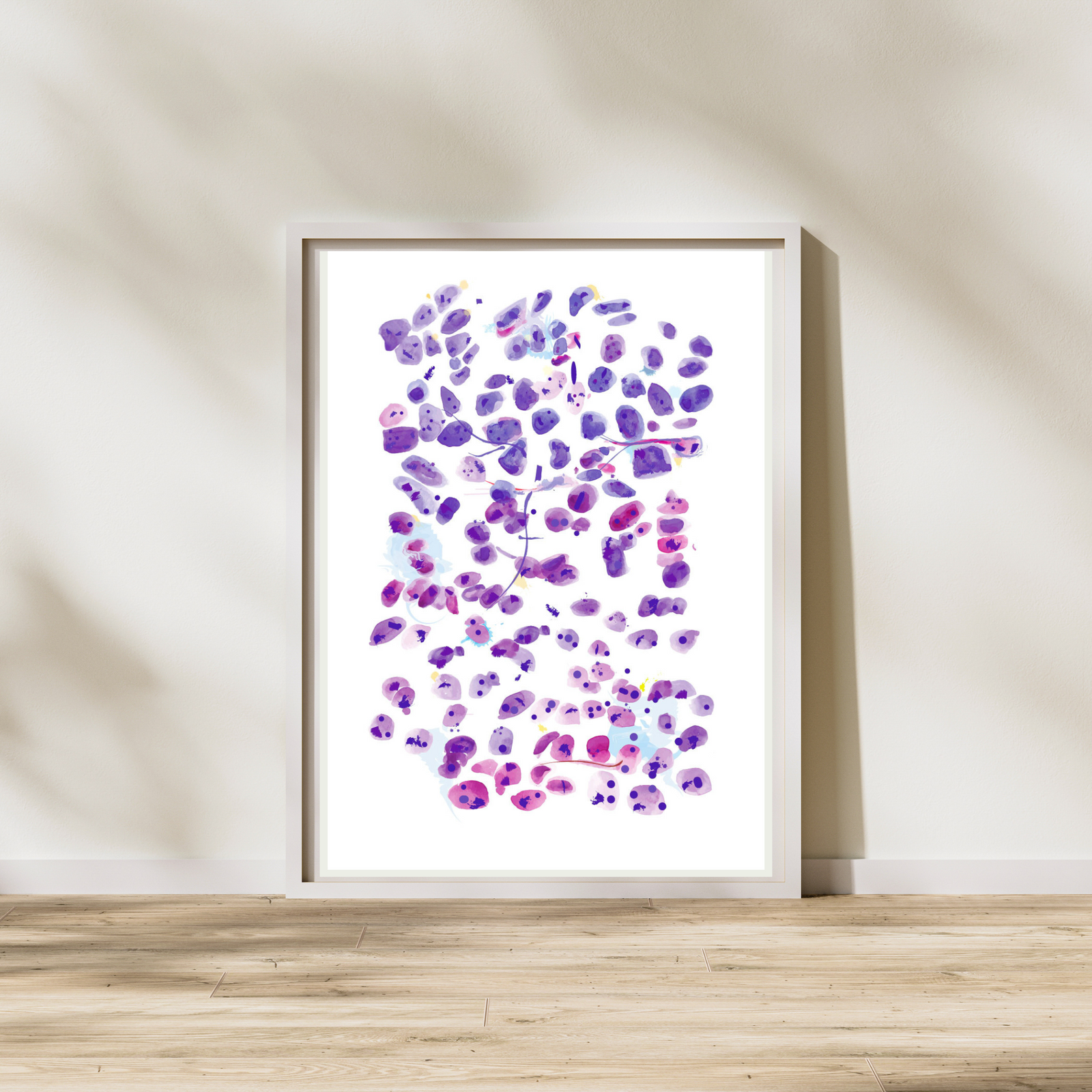 Prostate Adenocarcinoma, metastatic. Abstract Pathology Artwork, Histopathologist Gift