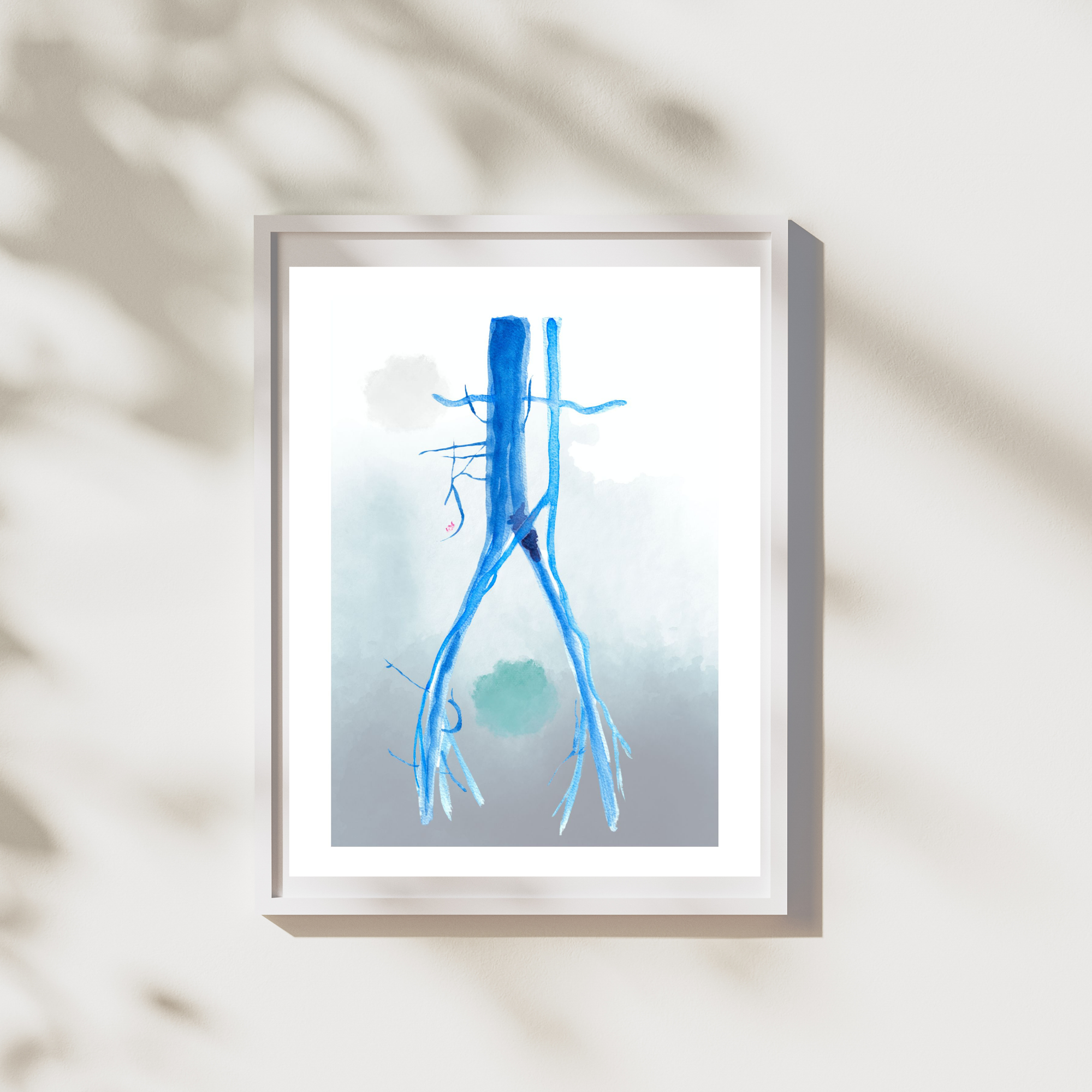 iliac vein compression watercolor painting
