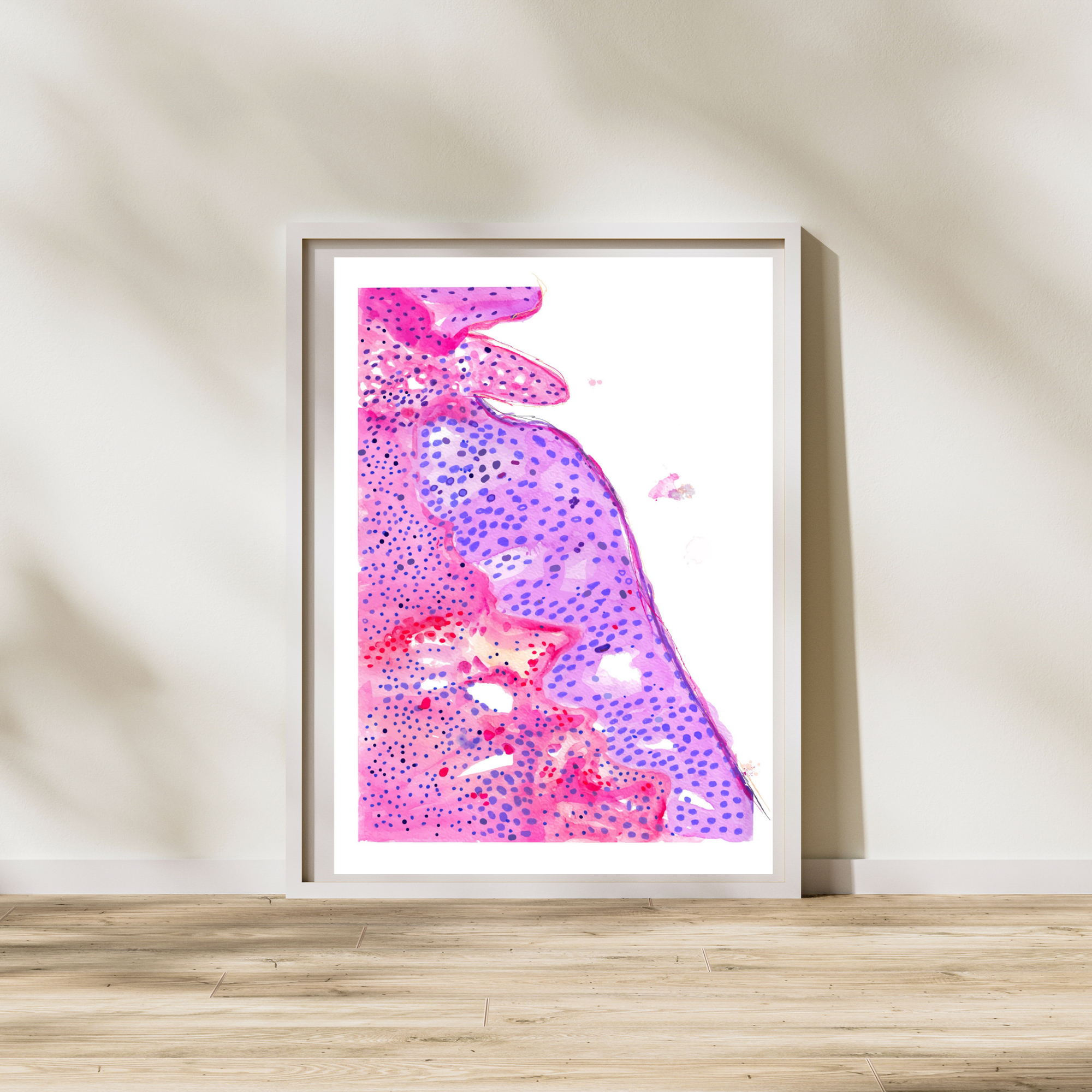 oral squamous cell carcinoma watercolor painting