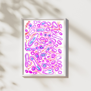 Prostate Adenocarcinoma Uropathology Art Print