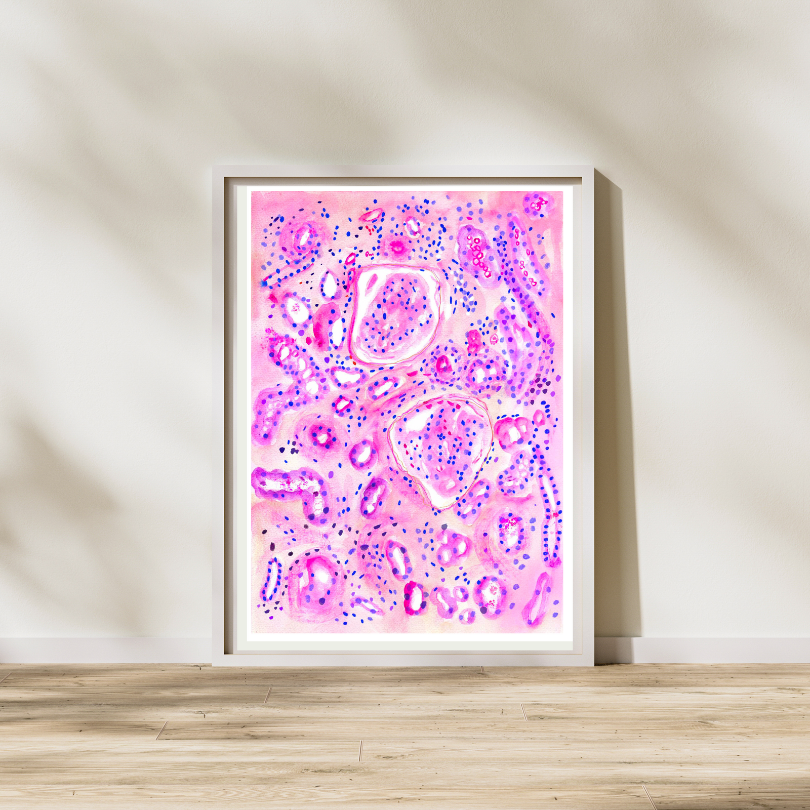 Diabetic Nephropathy Histopathology Watercolor Art Print