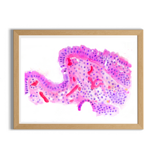 Barrett´s Esophagus Histopathology Art Print