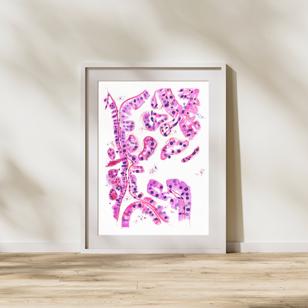thyroid papillary cancer watercolor art print