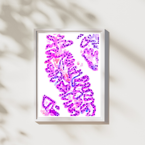 Urothelial Carcinoma Pathology Art